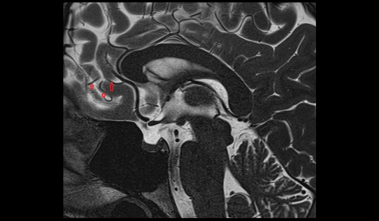 Polar frontal artery MRI T2 sagittal  image