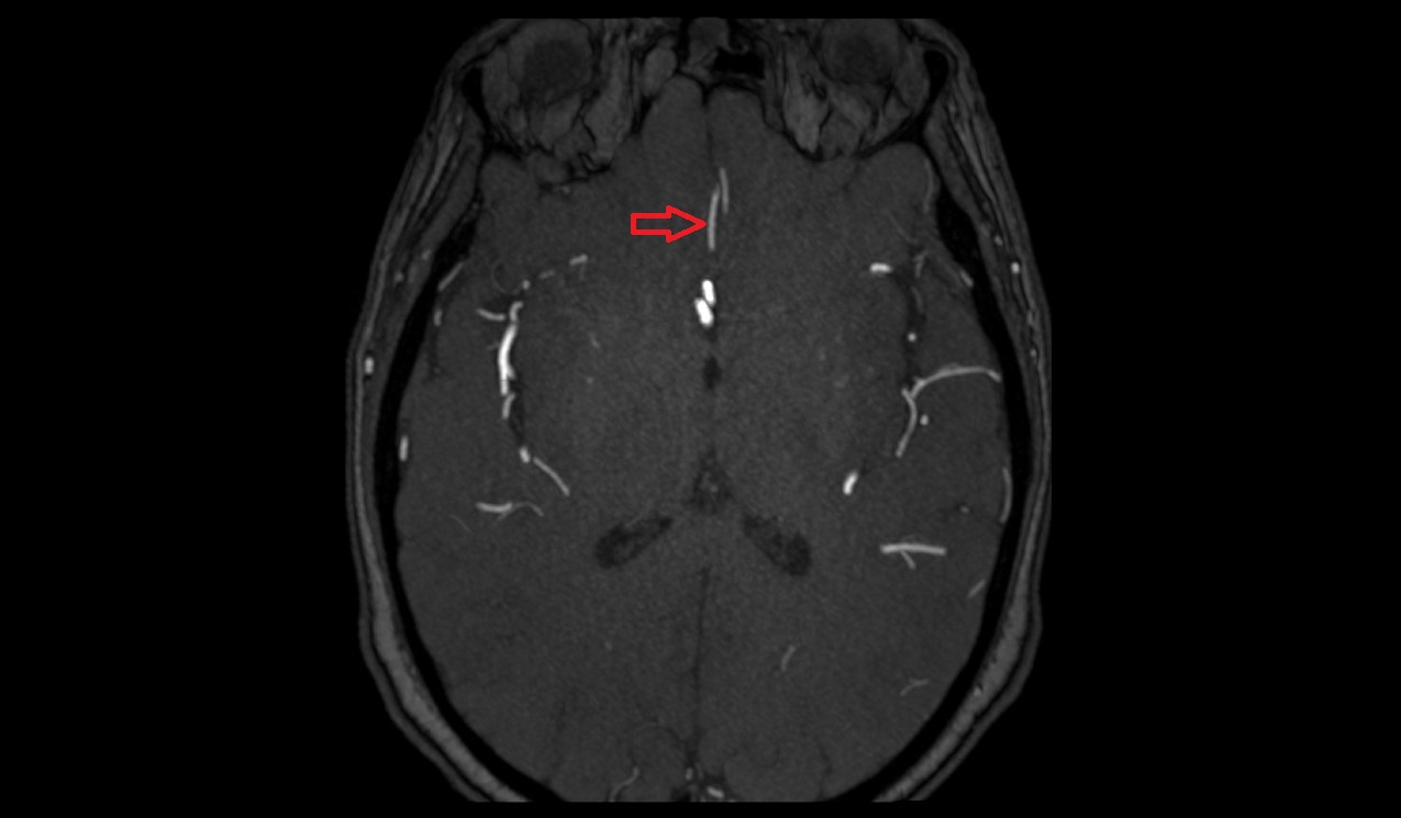 Polar frontal artery MRI TOF axial image