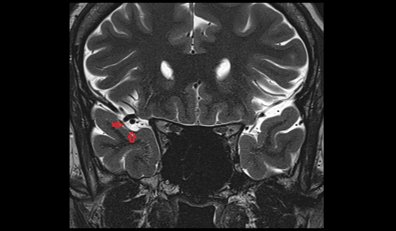 Polar temporal artery MRI 3T coronal image