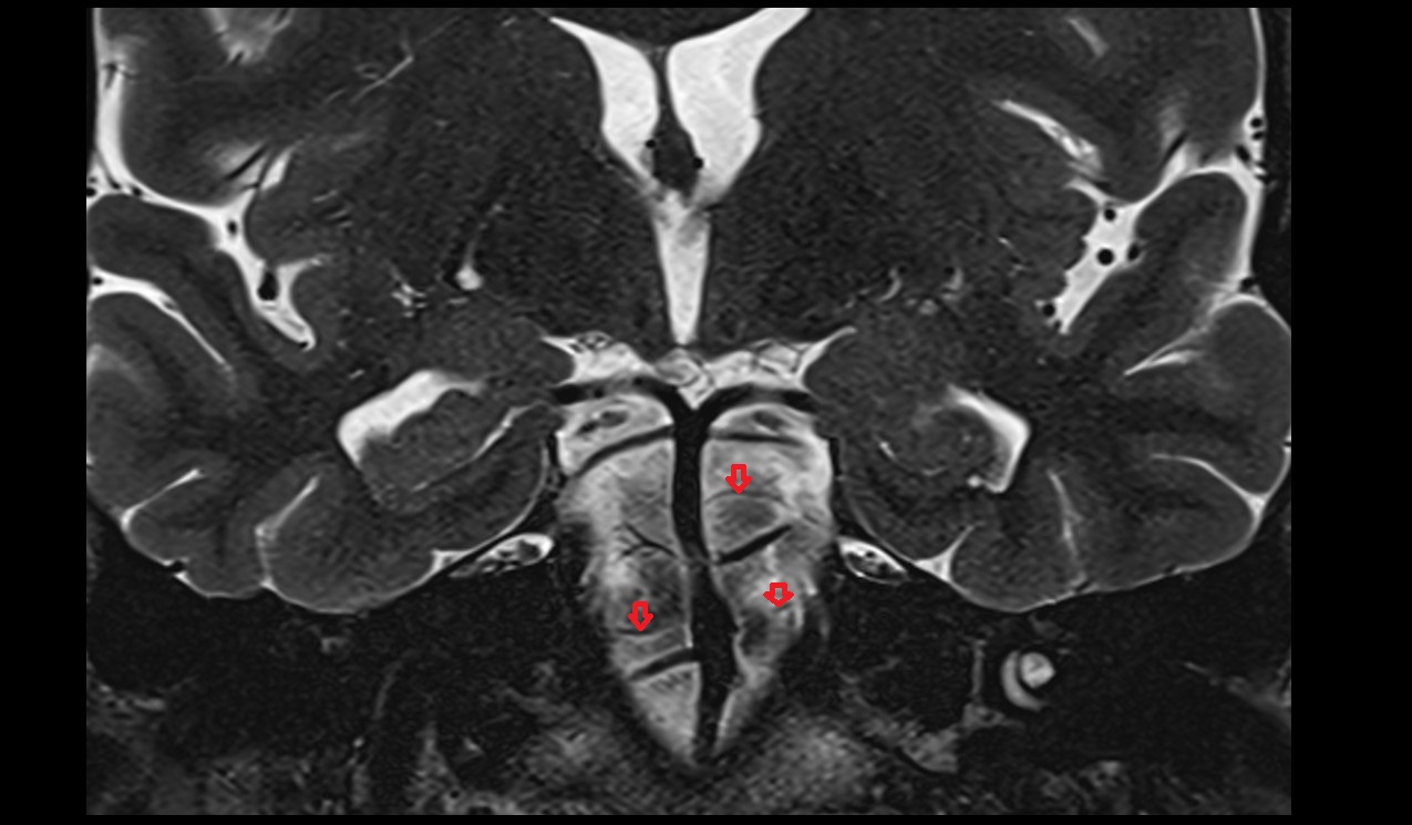 Pontine arteries coronal t2 mri image