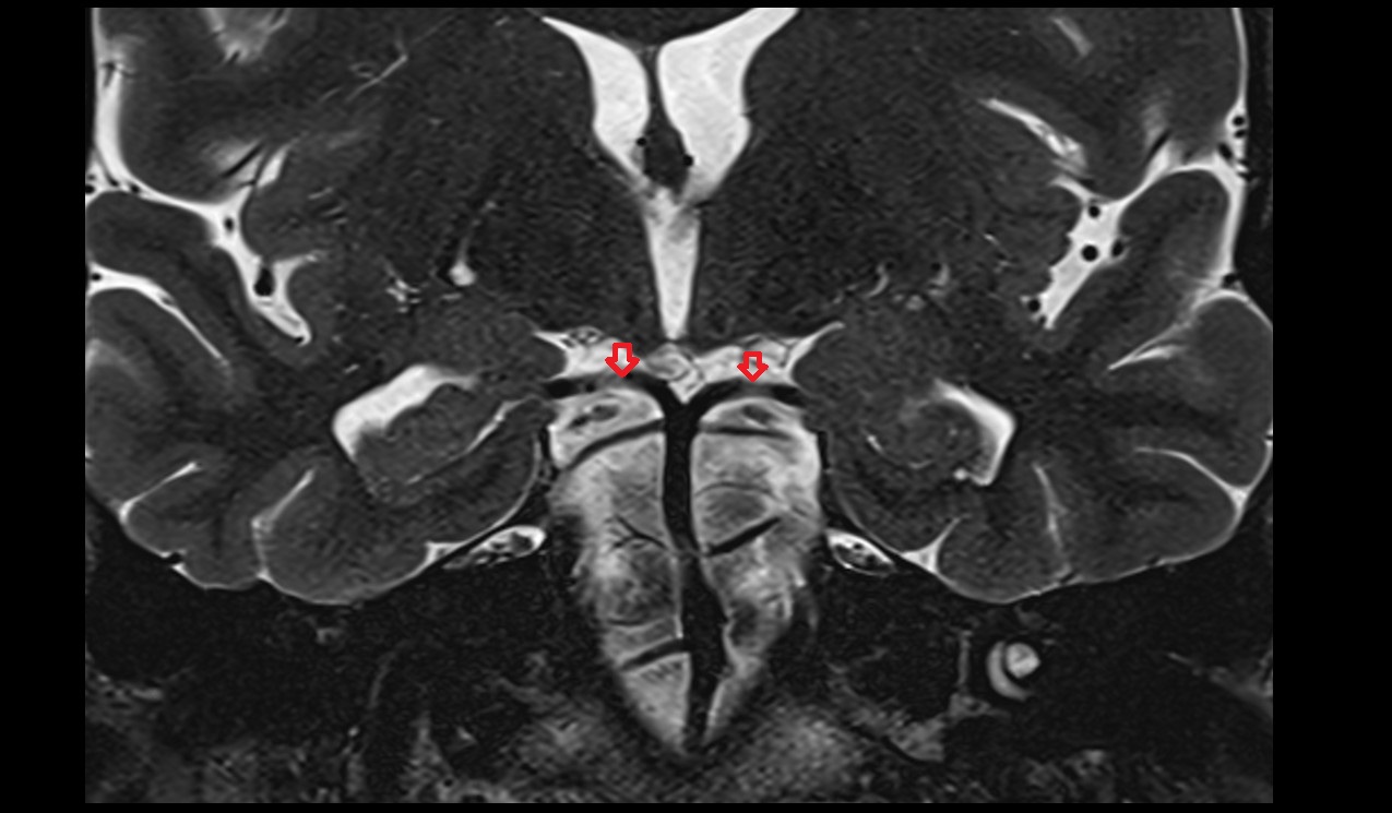 Posterior cerebral artery artery coronal  t2 3T MRI image