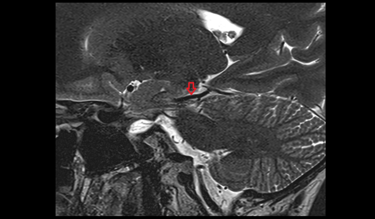 Posterior cerebral artery artery sagittal t2 3T MRI image