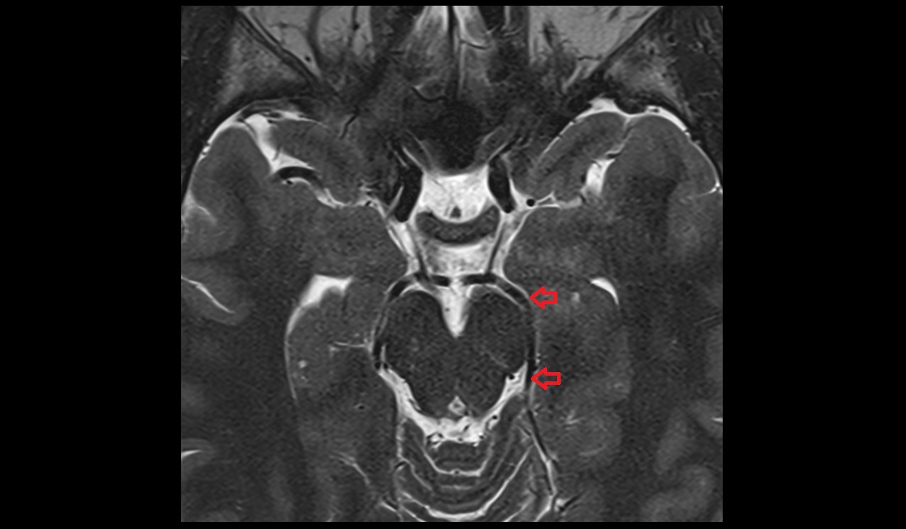 Posterior cerebral artery axial t2 3T MRI image