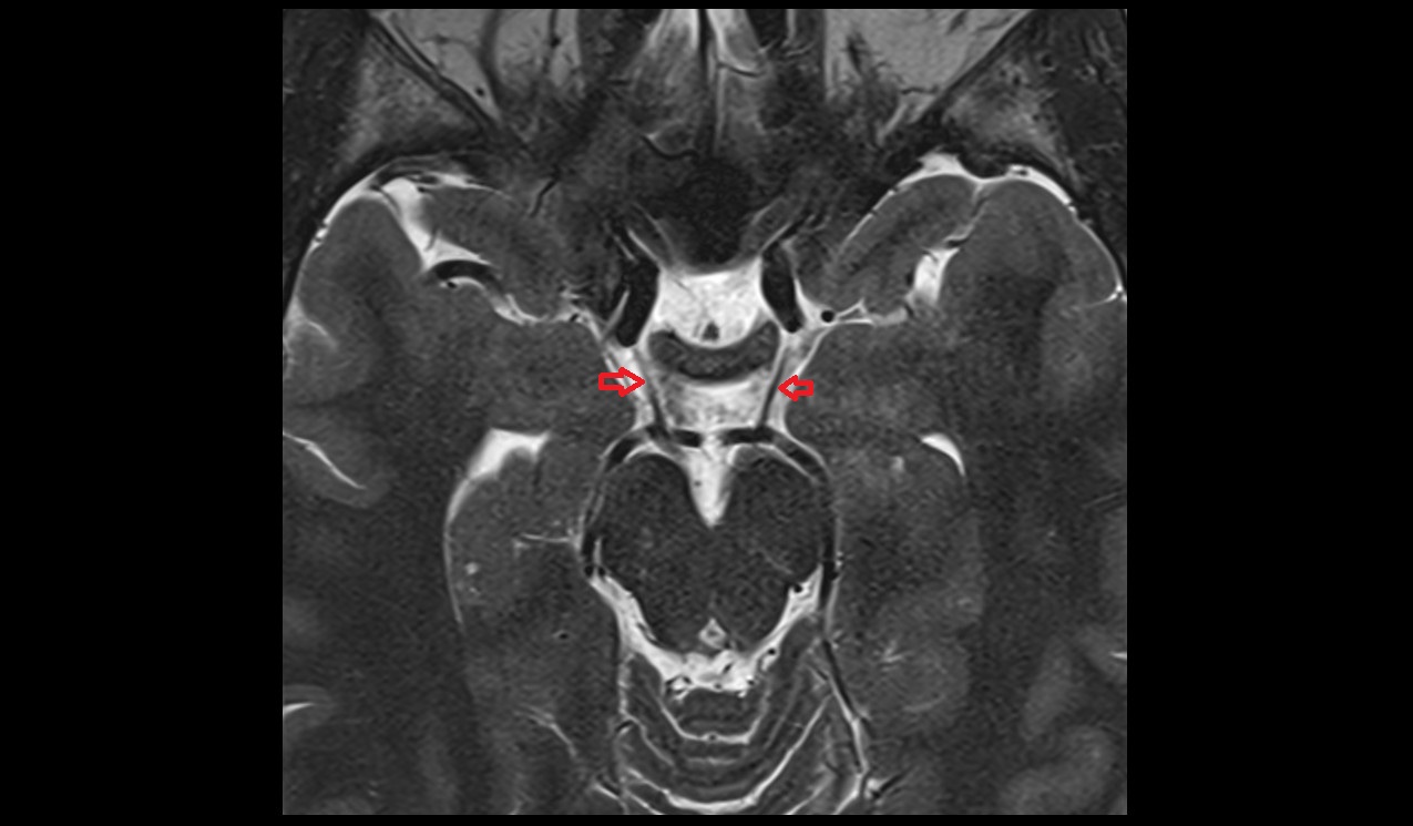 Posterior communicating artery axial t2 3T MRI image