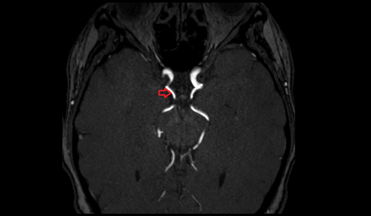 Posterior communicating artery axial TOF image