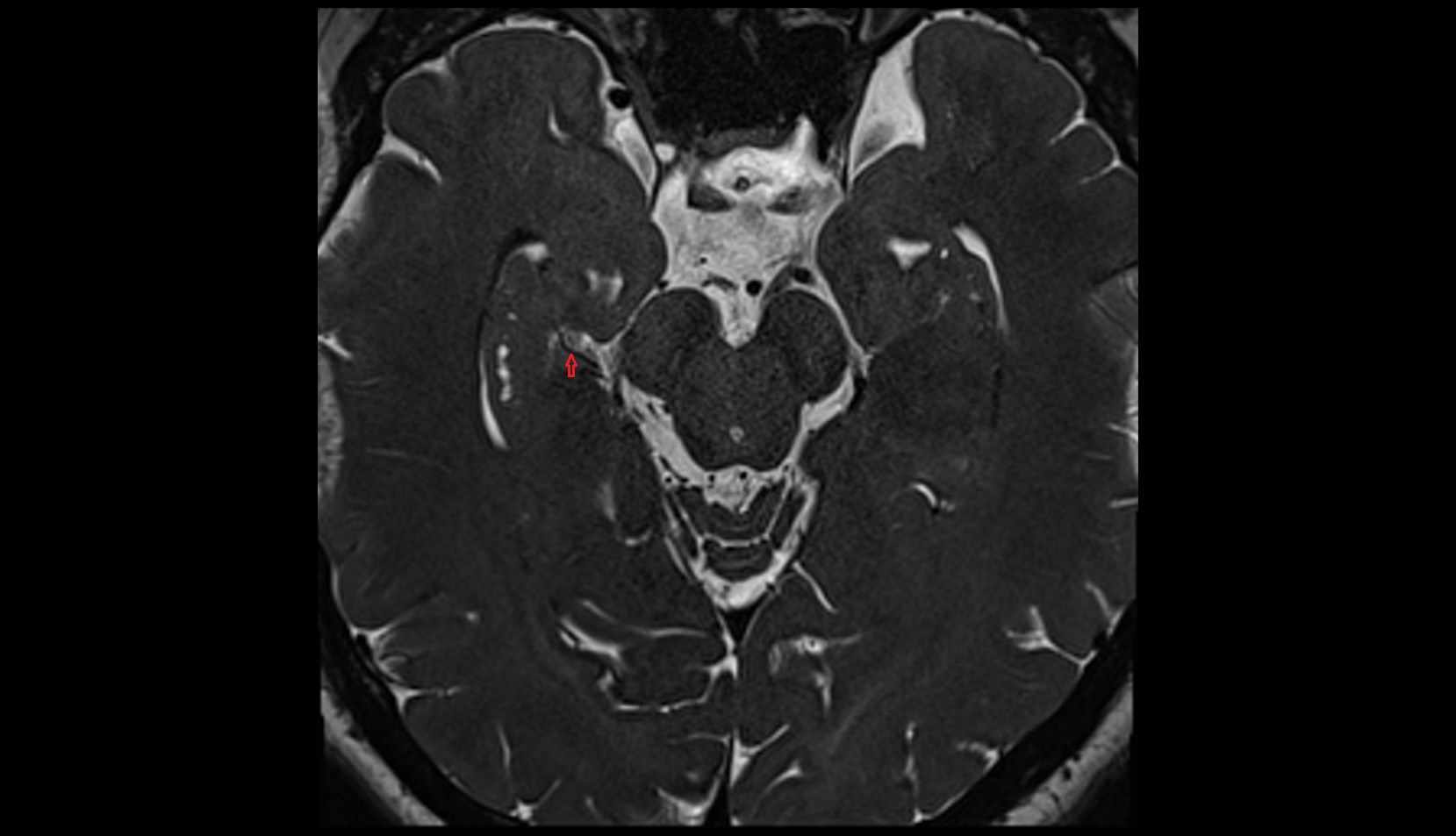 Posterior lateral choroidal artery MRI 3T axial image 1