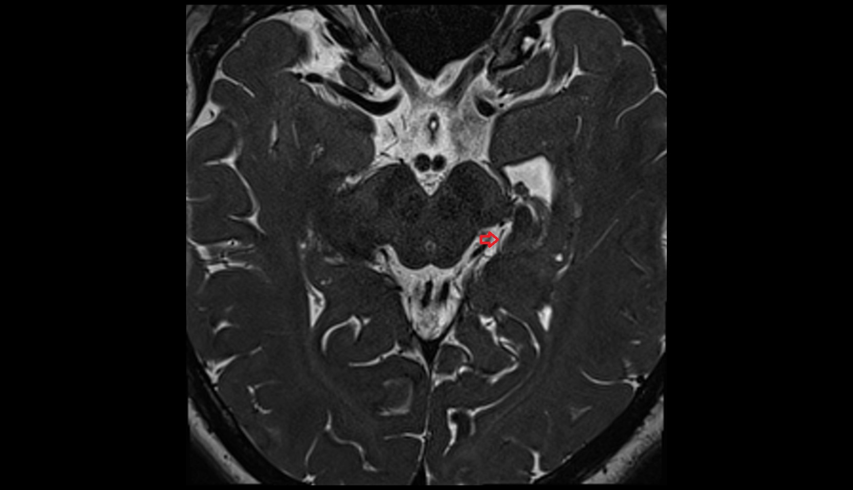 Posterior lateral choroidal artery MRI 3T axial image