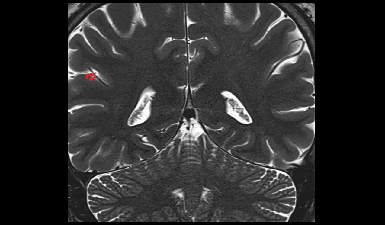 Posterior parietal artery MRI 3T coronal image