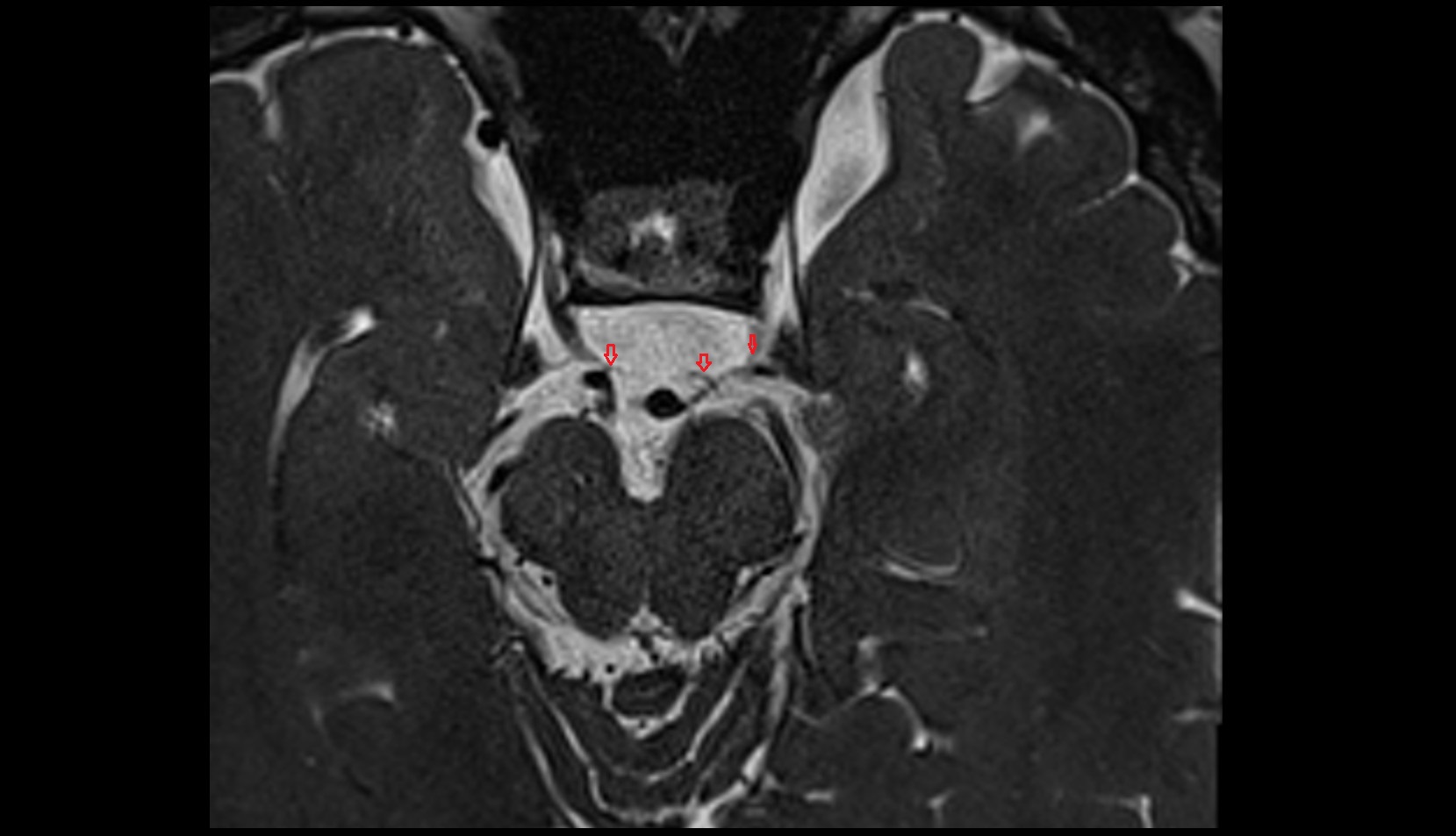 Posteromedial central (perforating) arteries mri 3t axial image