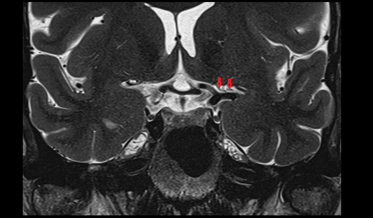 Anterolateral central (lenticulostriate) arteries MRI 3T coronal image