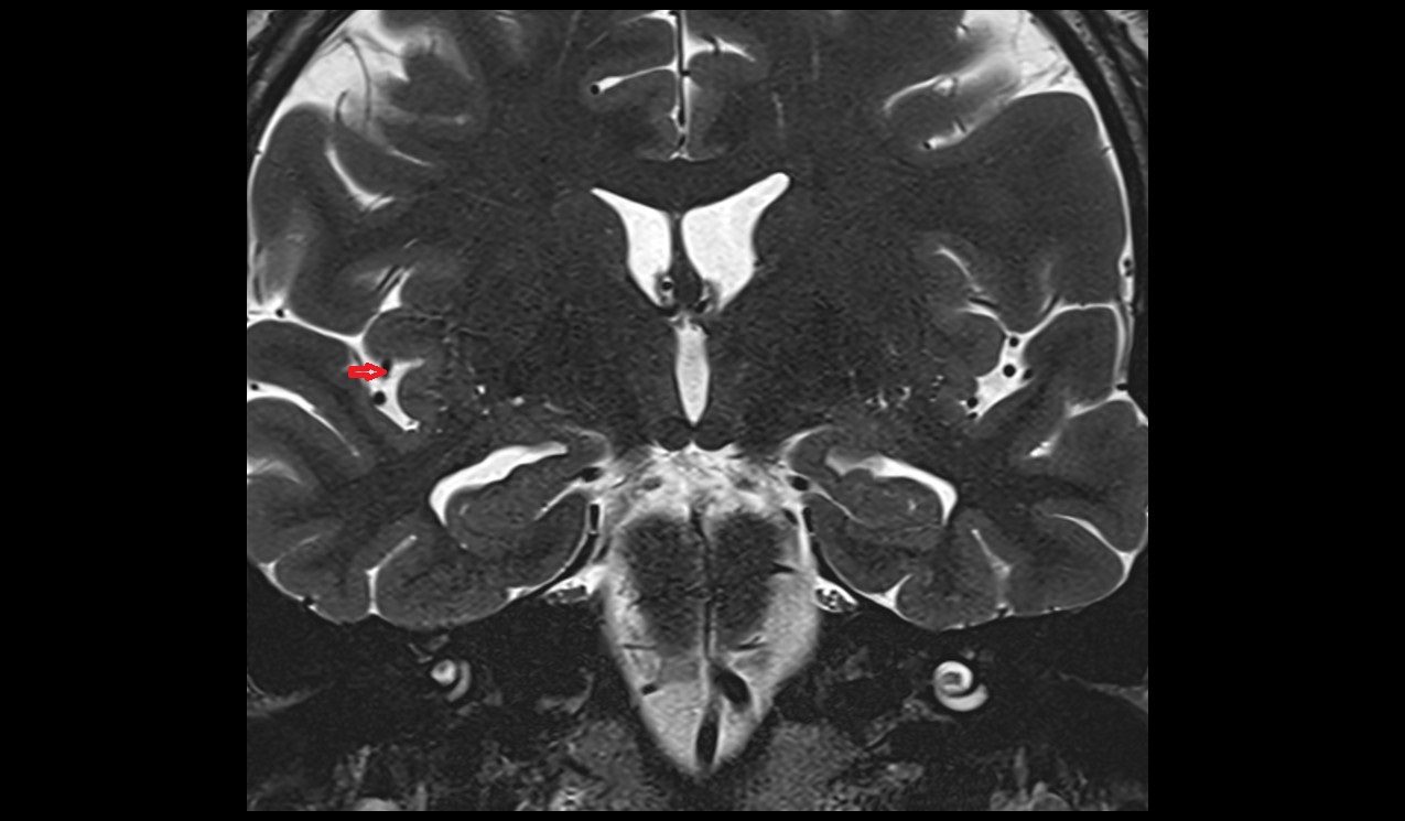 Artery of precentral sulcus MRI 3T coronal image