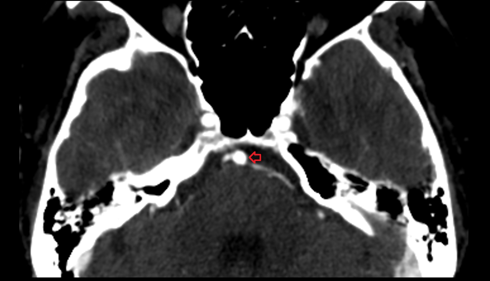 Basilar artery CT image