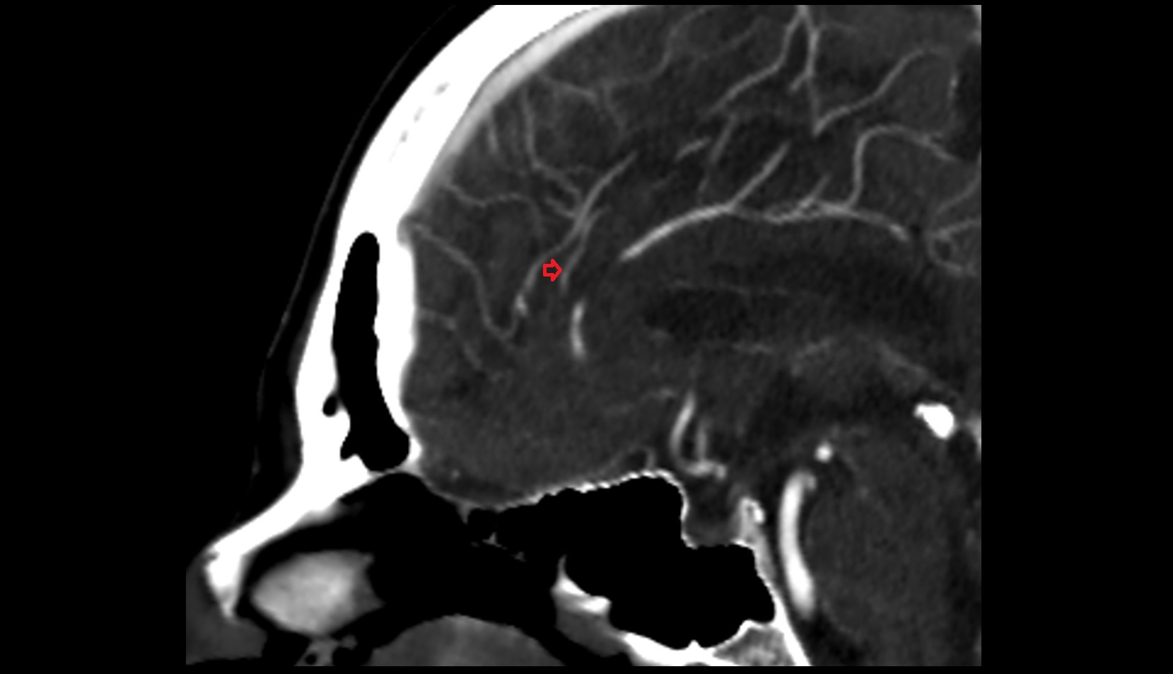 Callosomarginal artery ct image
