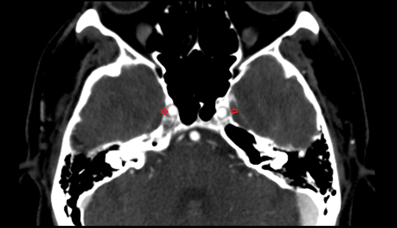 Internal carotid artery ct axial images