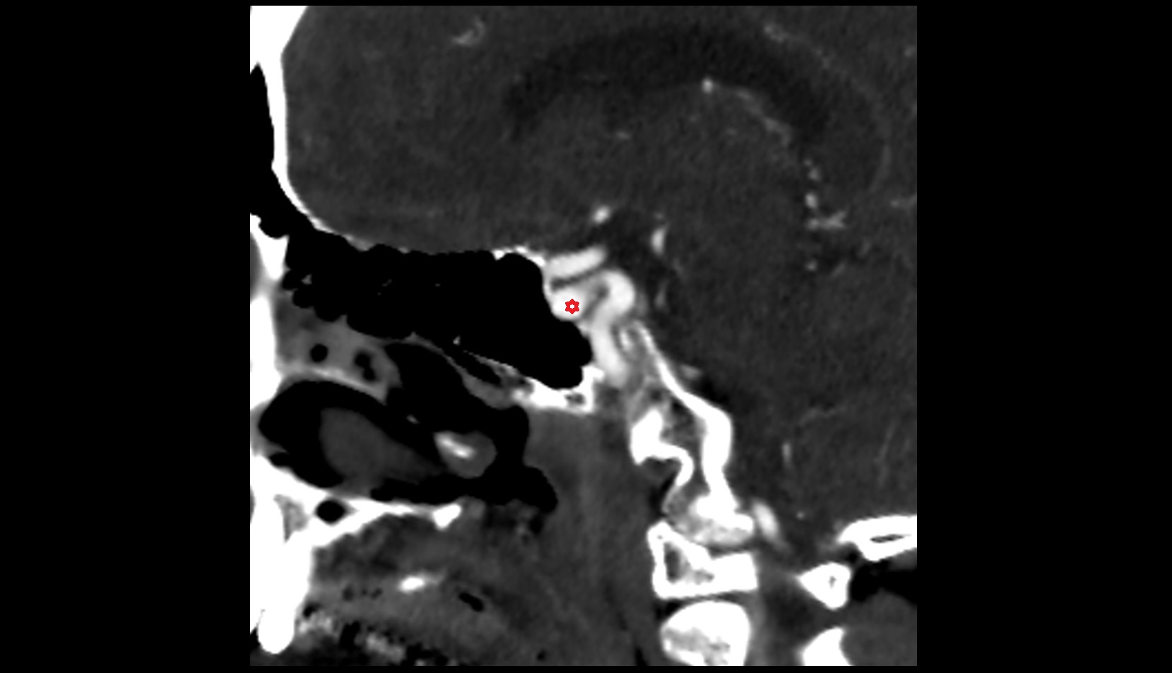 Internal carotid artery ct sagittal images