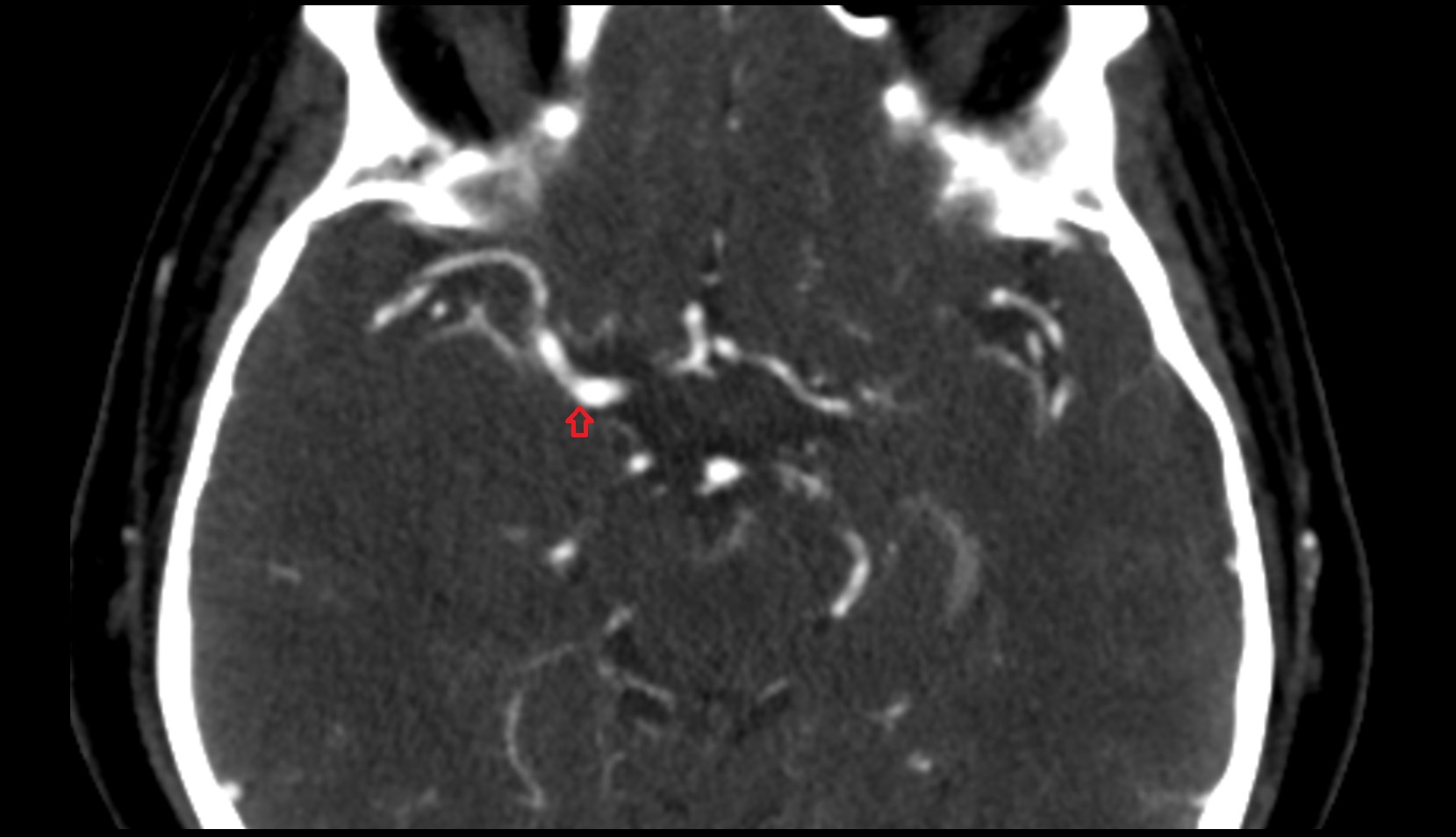 Middle cerebral artery (Sylvian artery) ct images