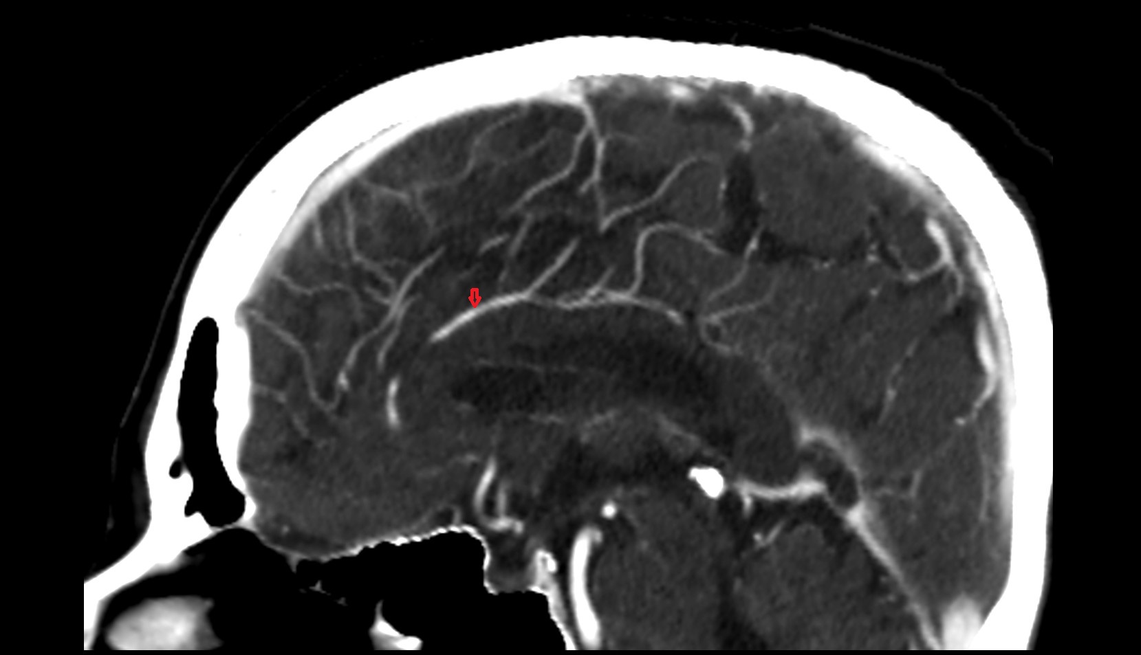 Pericallosal artery ct image