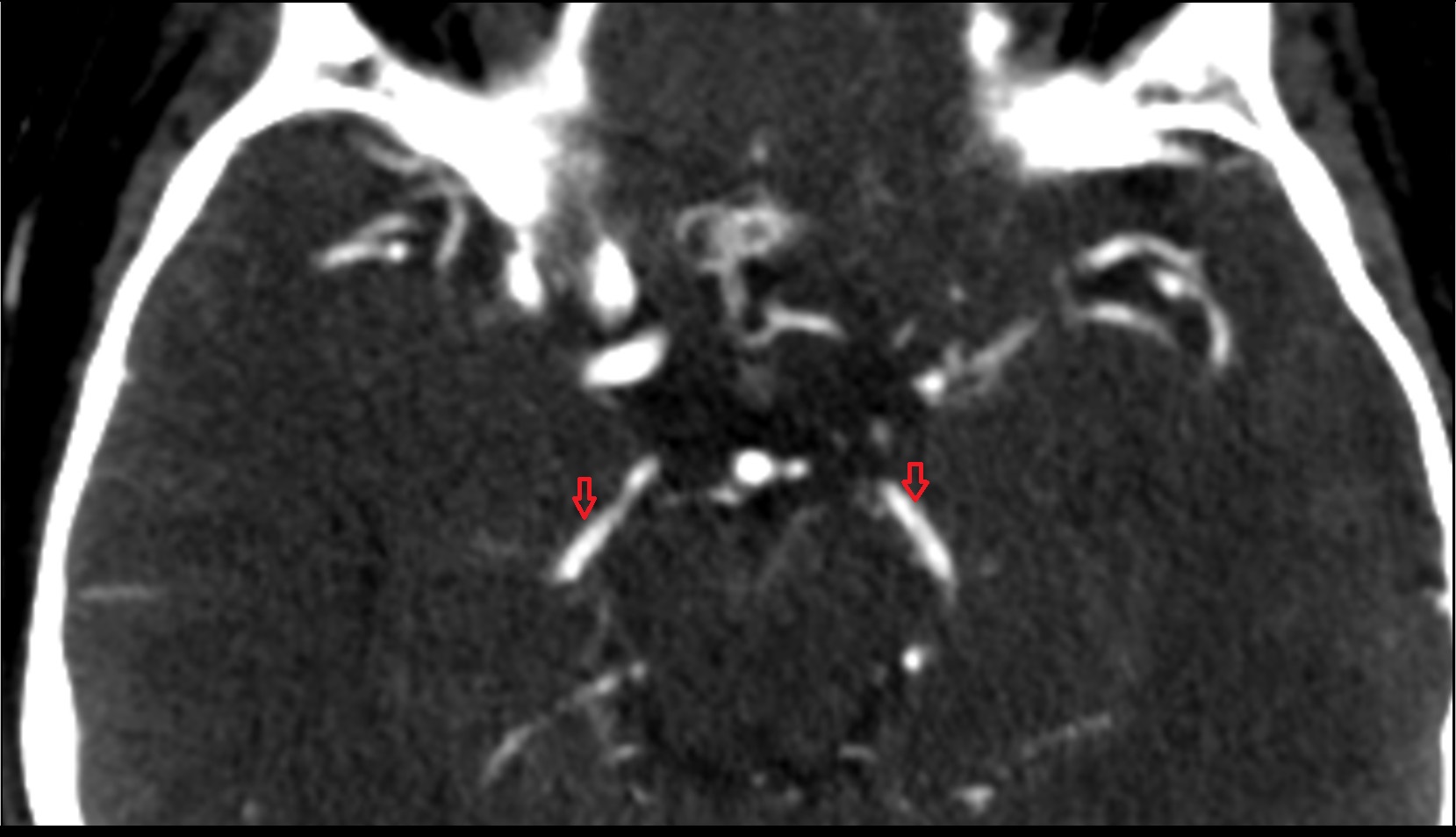 Posterior cerebral artery ct image