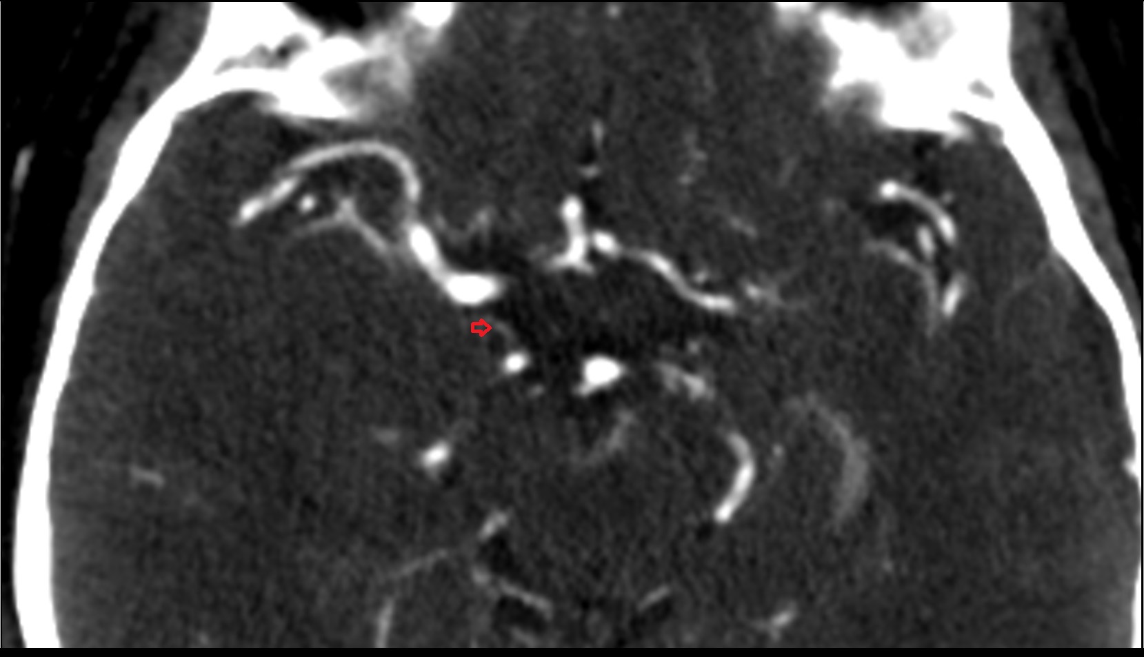 Posterior communicating artery ct images