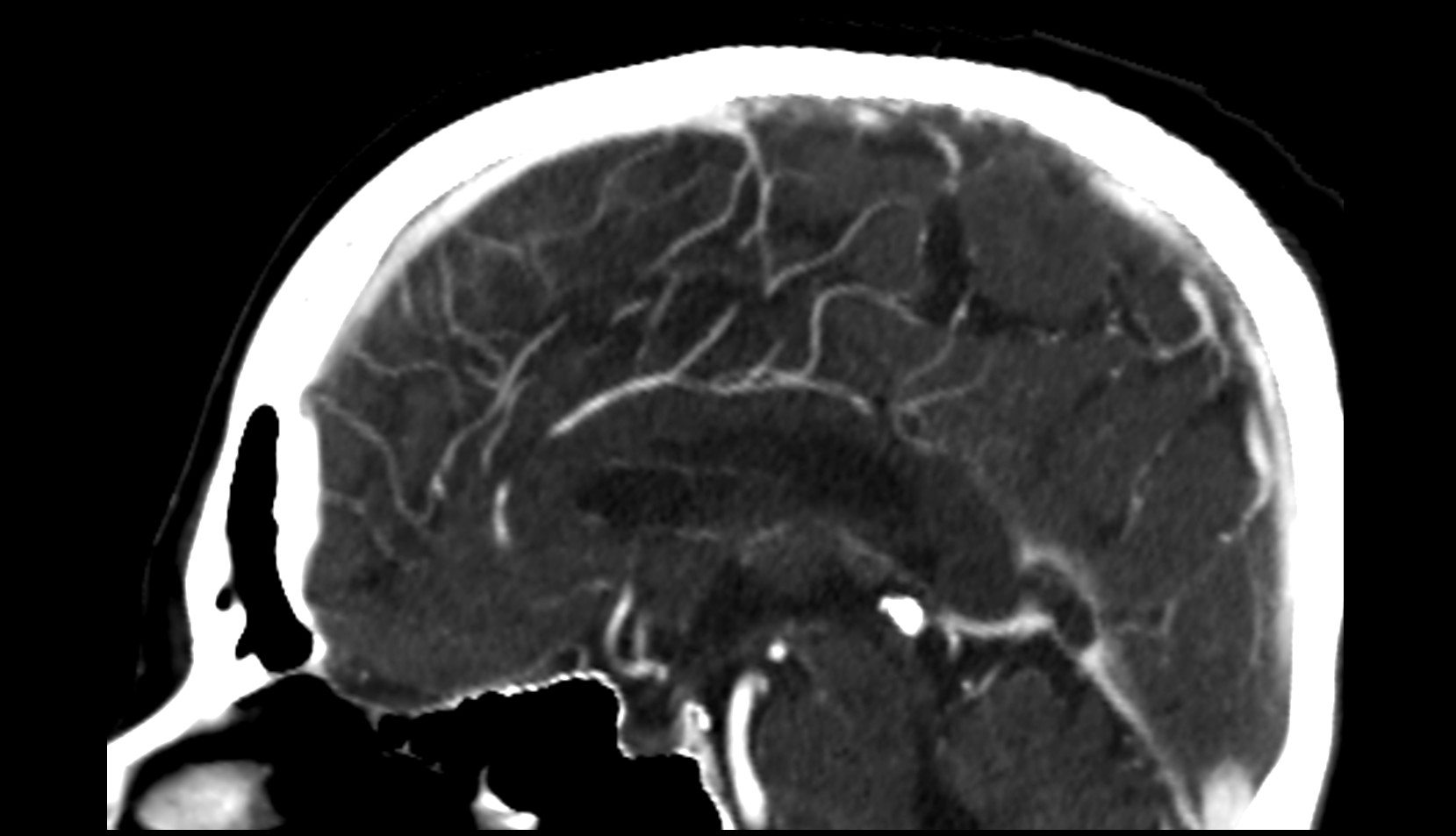 Paracentral artery ct image