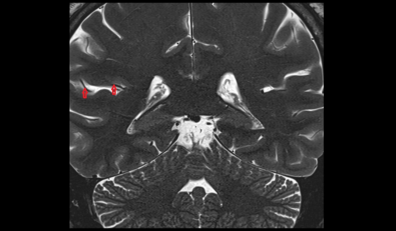 Artery of postcentral sulcus (anterior parietal artery) anatomy