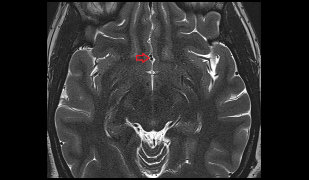 Anterior cerebral artery axial T2 3T MRI  image