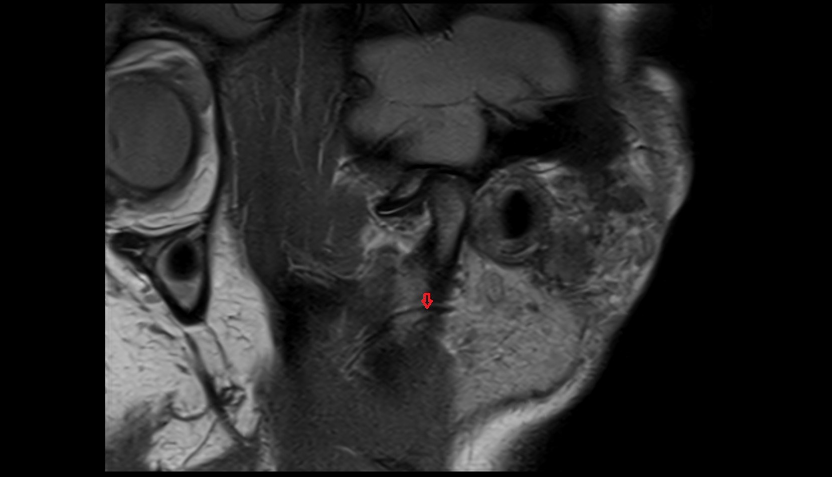 transverse facial artery MRI IMAGE