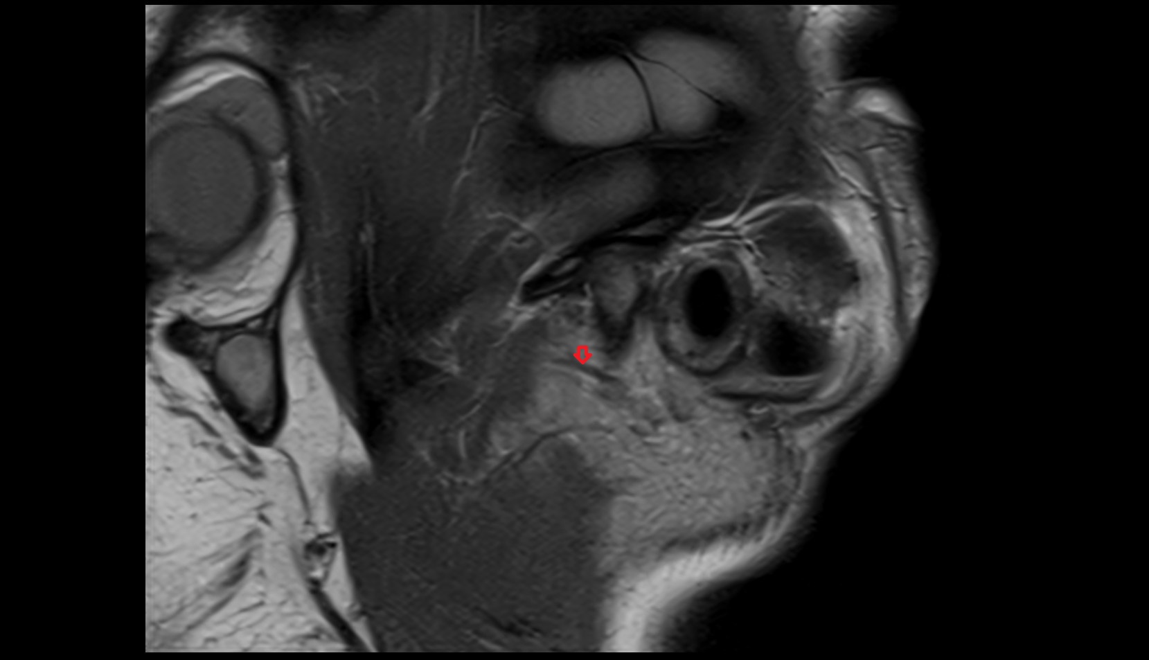 transverse facial vein mri image