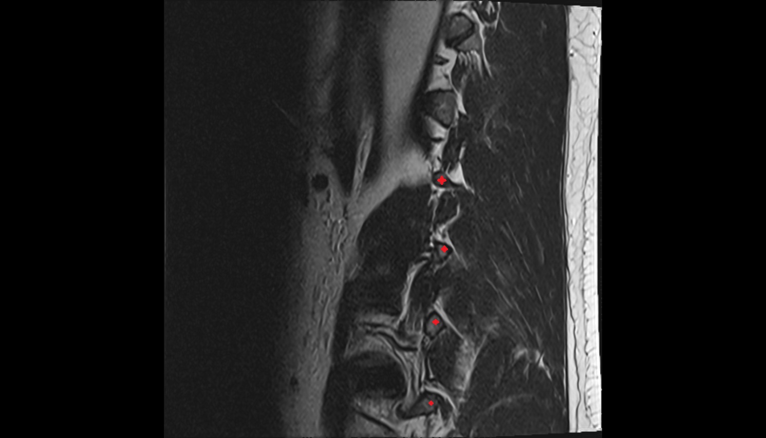 transverse processes  MRI SAG  anatomy  image -img-00000-00000