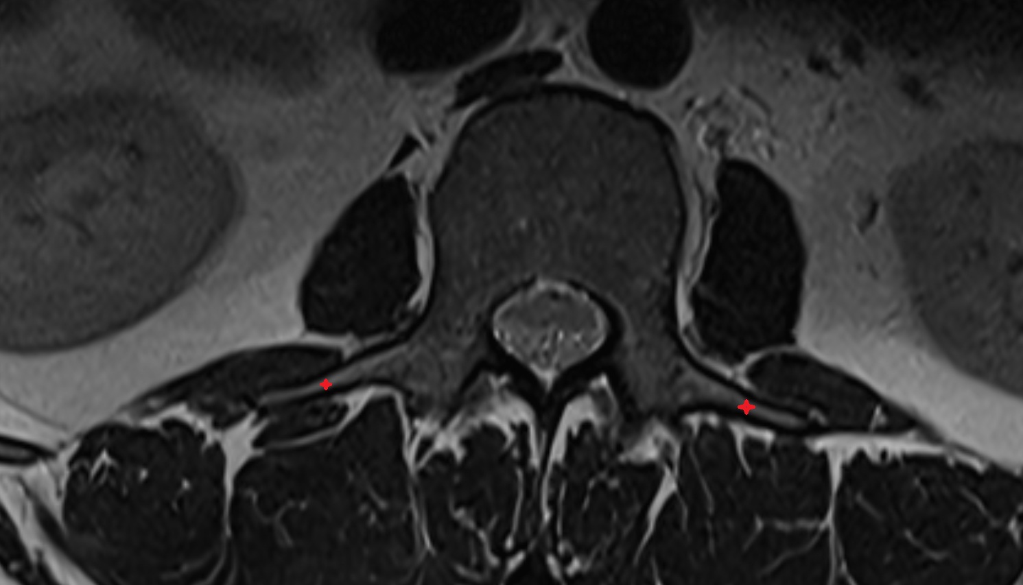 transverse processes  MRI axial anatomy  image -img-00000-00000