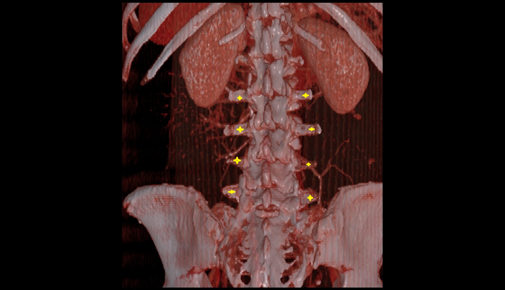 transverse processes of vertebrae ct 3d image