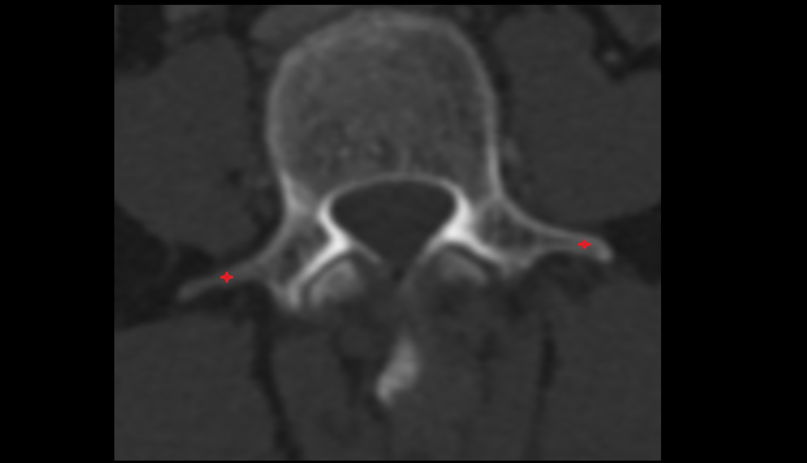 transverse processes of vertebrae ct axial image