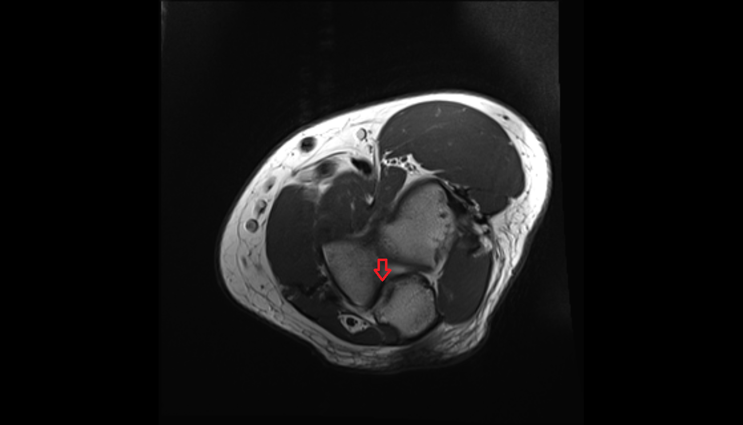 trochlear notch of ulna axial  cross sectional anatomy 3T MRI AI enhanced radiology image -img-00000-00000