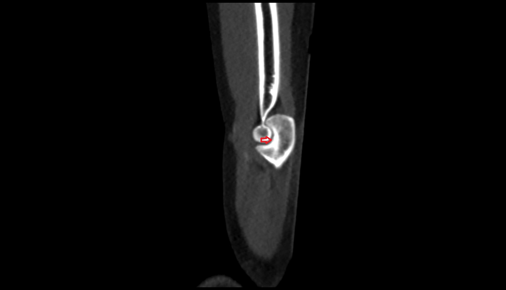 trochlear notch of ulna ct sag image