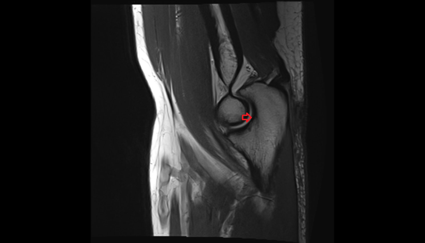 trochlear notch of ulna sag  cross sectional anatomy 3T MRI AI enhanced radiology image -img-00000-00000