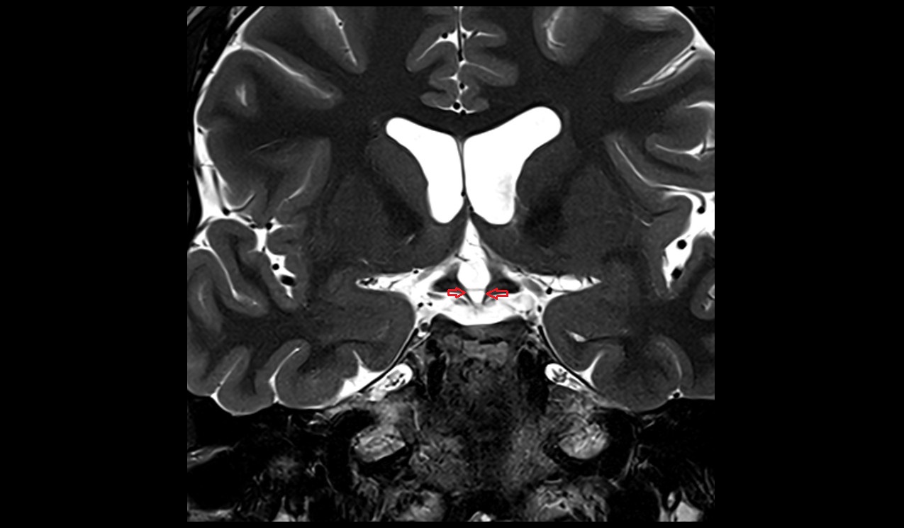 tuber cinereum mri 3t coronal image