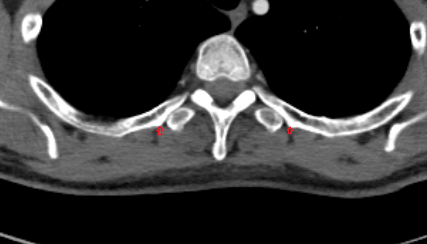 tubercle of rib CT axial  image -img-00000-00000