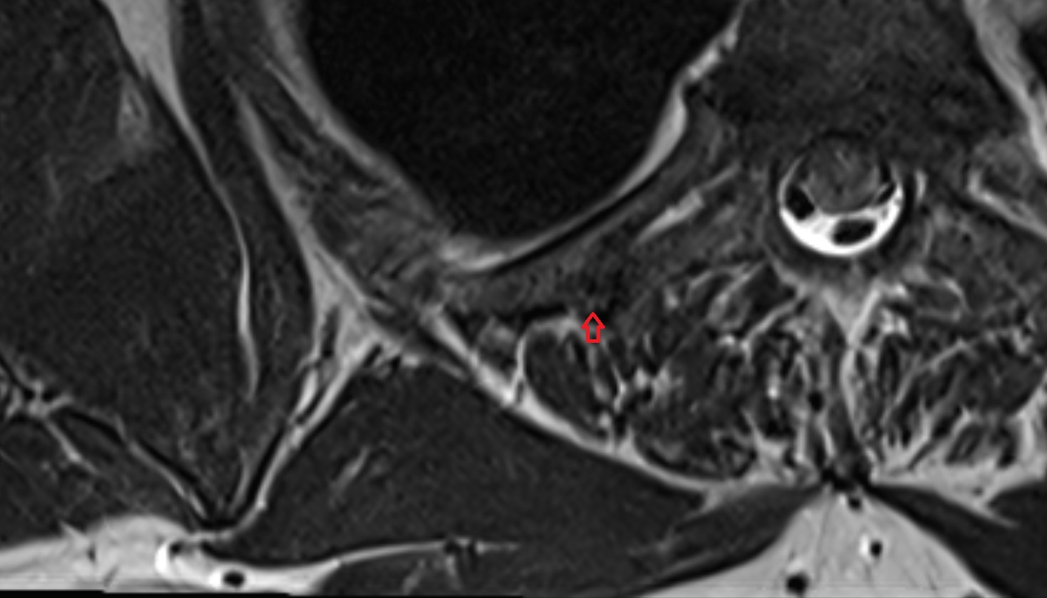tubercle of rib MRI  axial  image -img-00000-00000