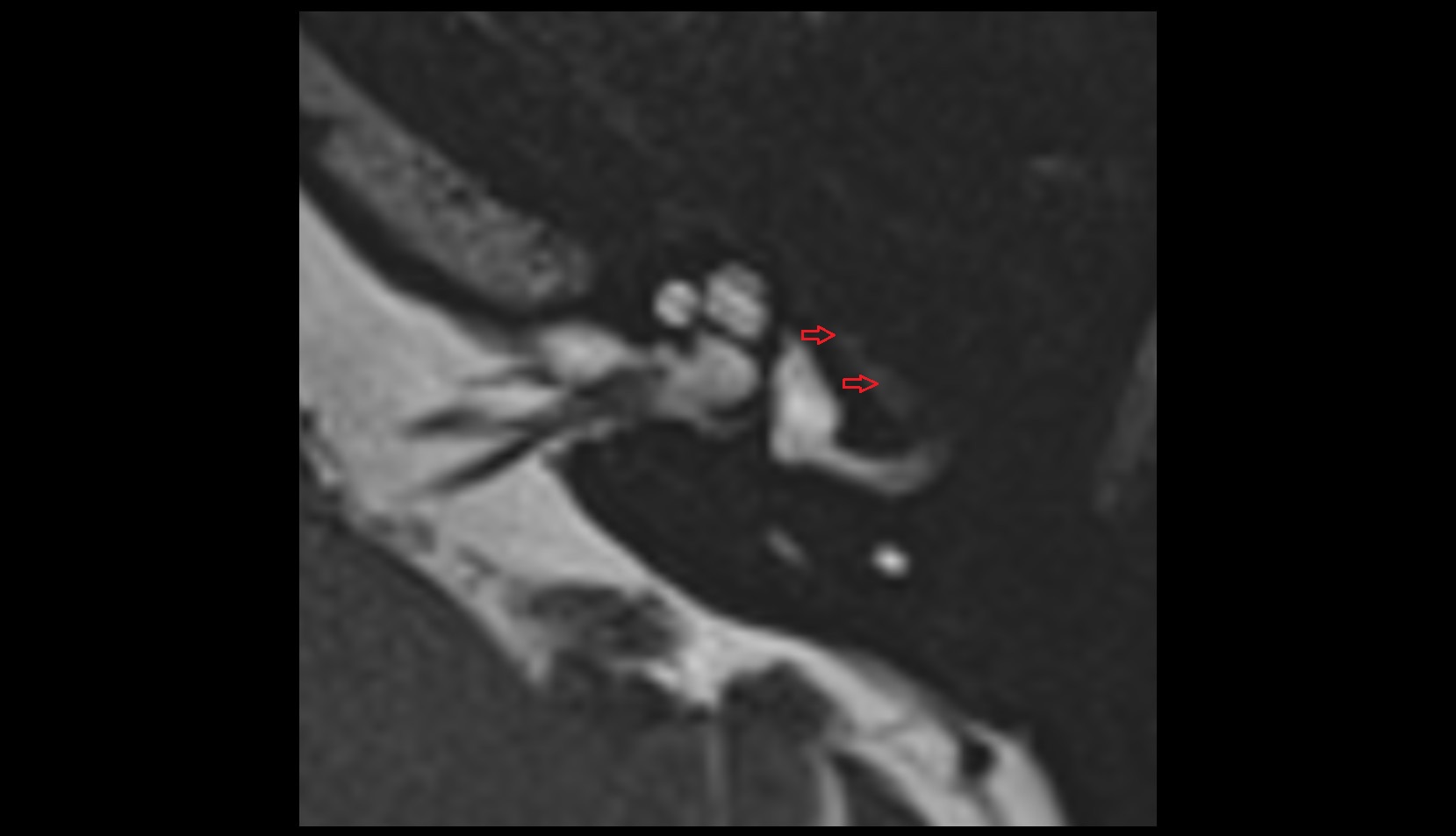 tympanic segment of facial nerve axil mri image