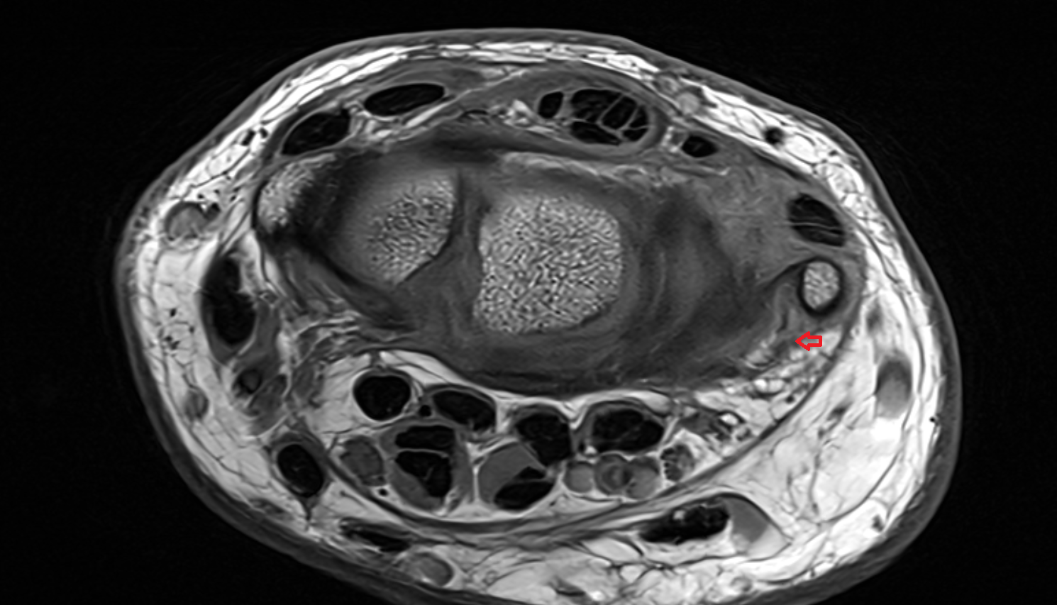 ulnar collateral ligament of wrist  mri coronal image  axial cross sectional anatomy 3T MRI AI enhanced radiology image-img-00000-00000