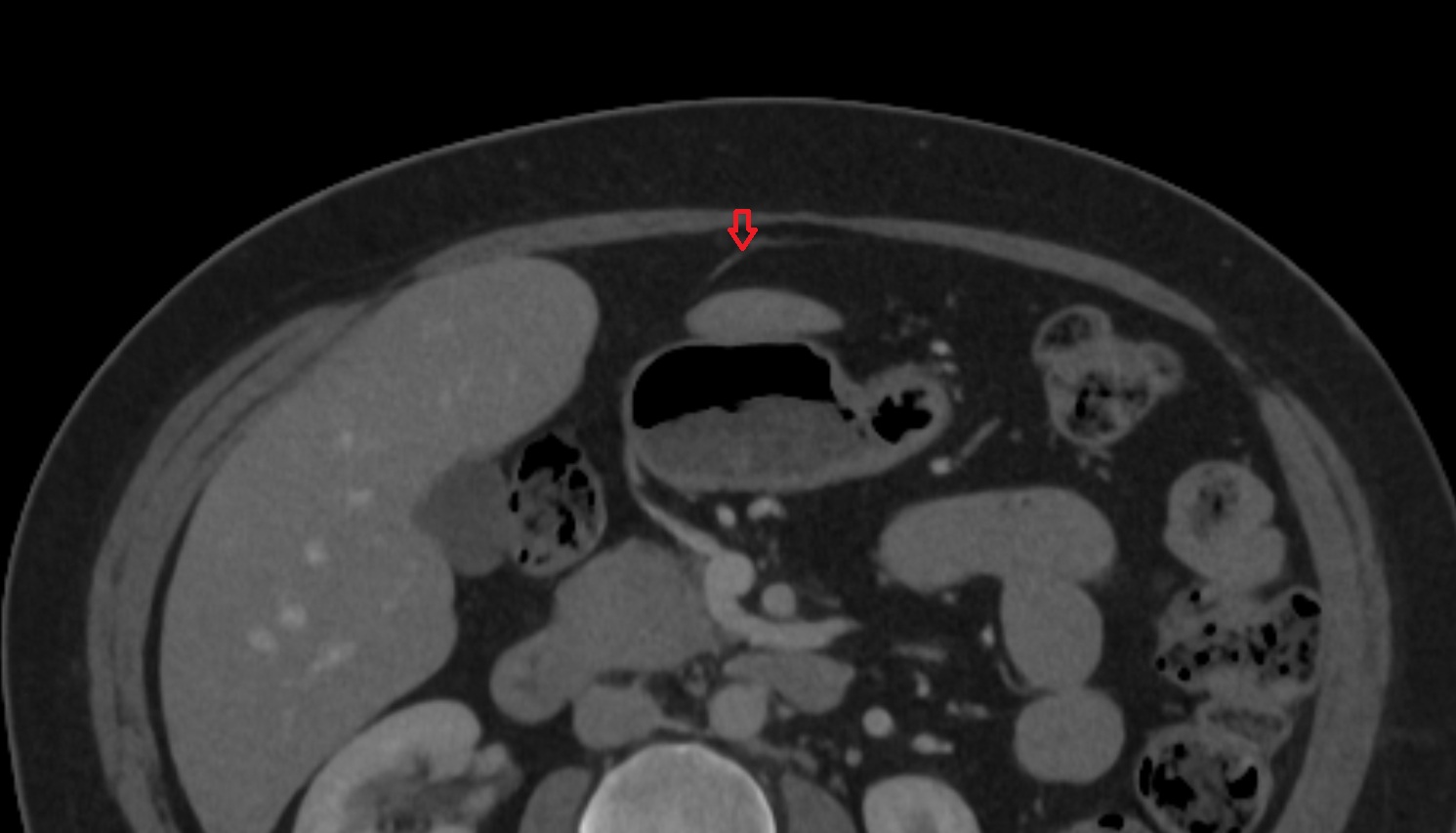 umbilical vein   CT axial  anatomy  image -img-00000-00000