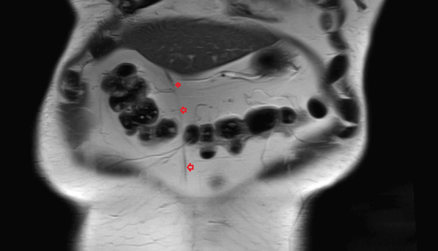 umbilical vein   MRI coronal  anatomy  image -img-00000-00000