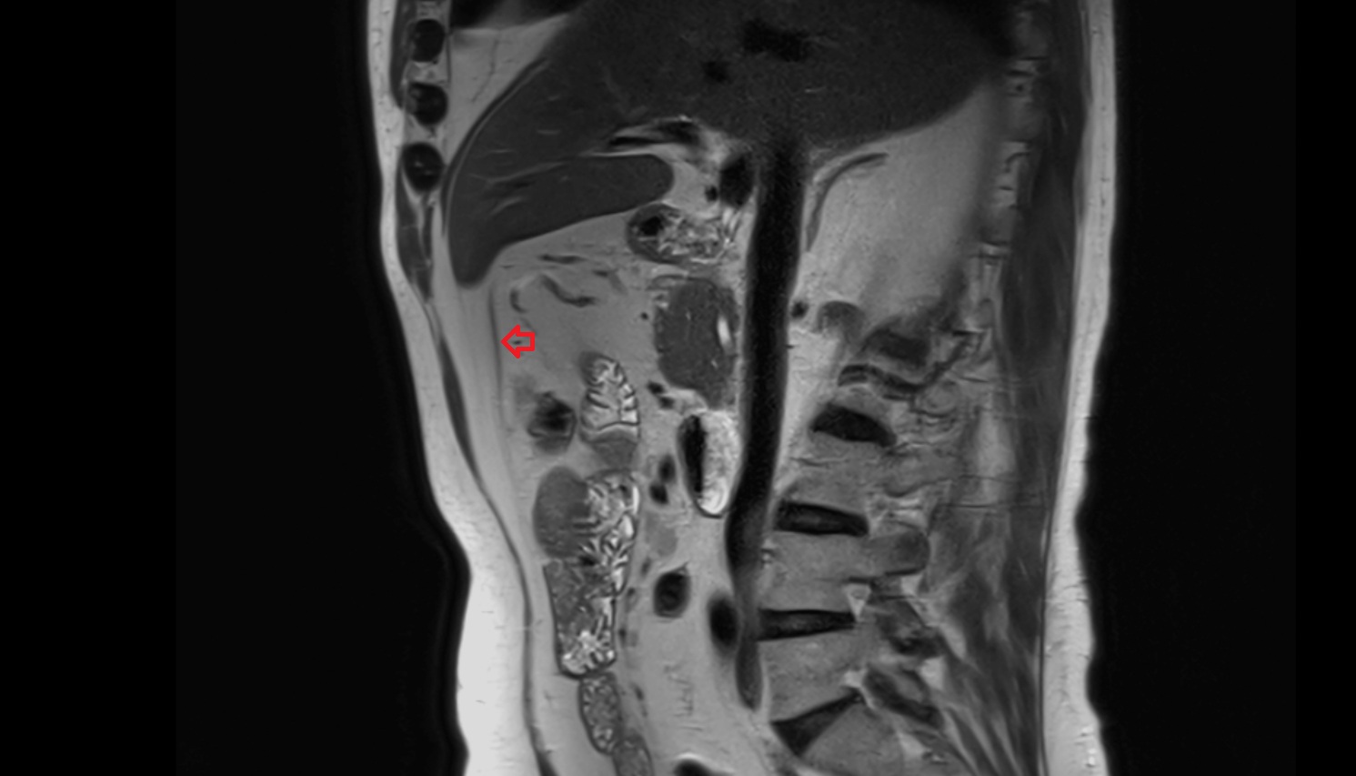 umbilical vein   MRIsagittal  anatomy  image -img-00000-00000