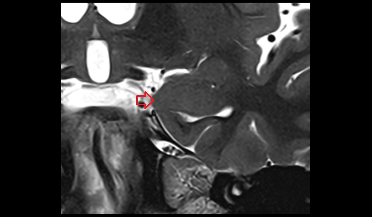 uncus mri 3t coronal image