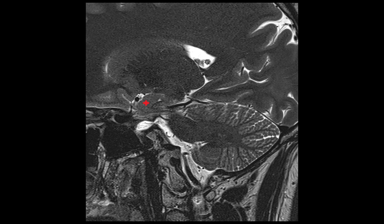 uncus mri 3t sagittal image