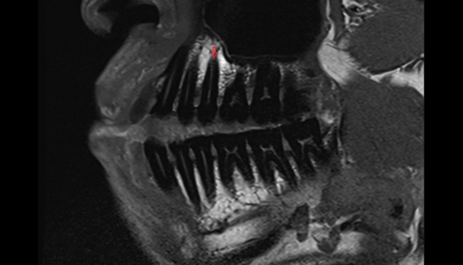 upper premolar apical foramen  mri sagittal  image -img-00000-00000