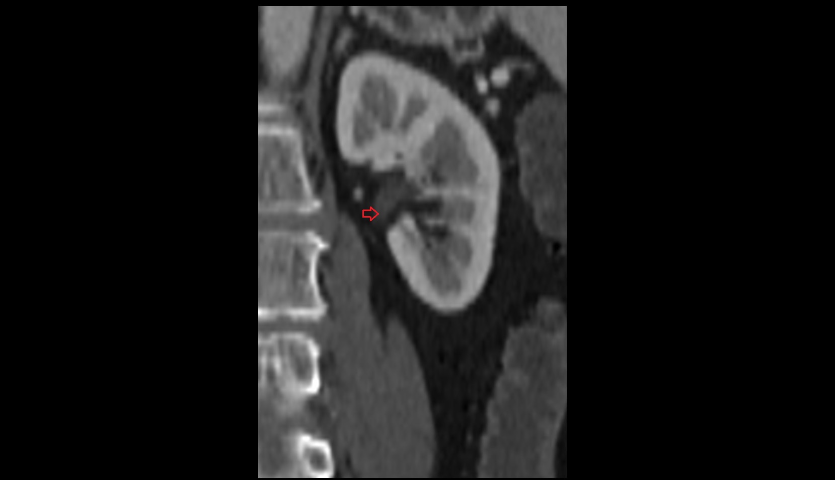 ureteropelvic junction CT coronal image