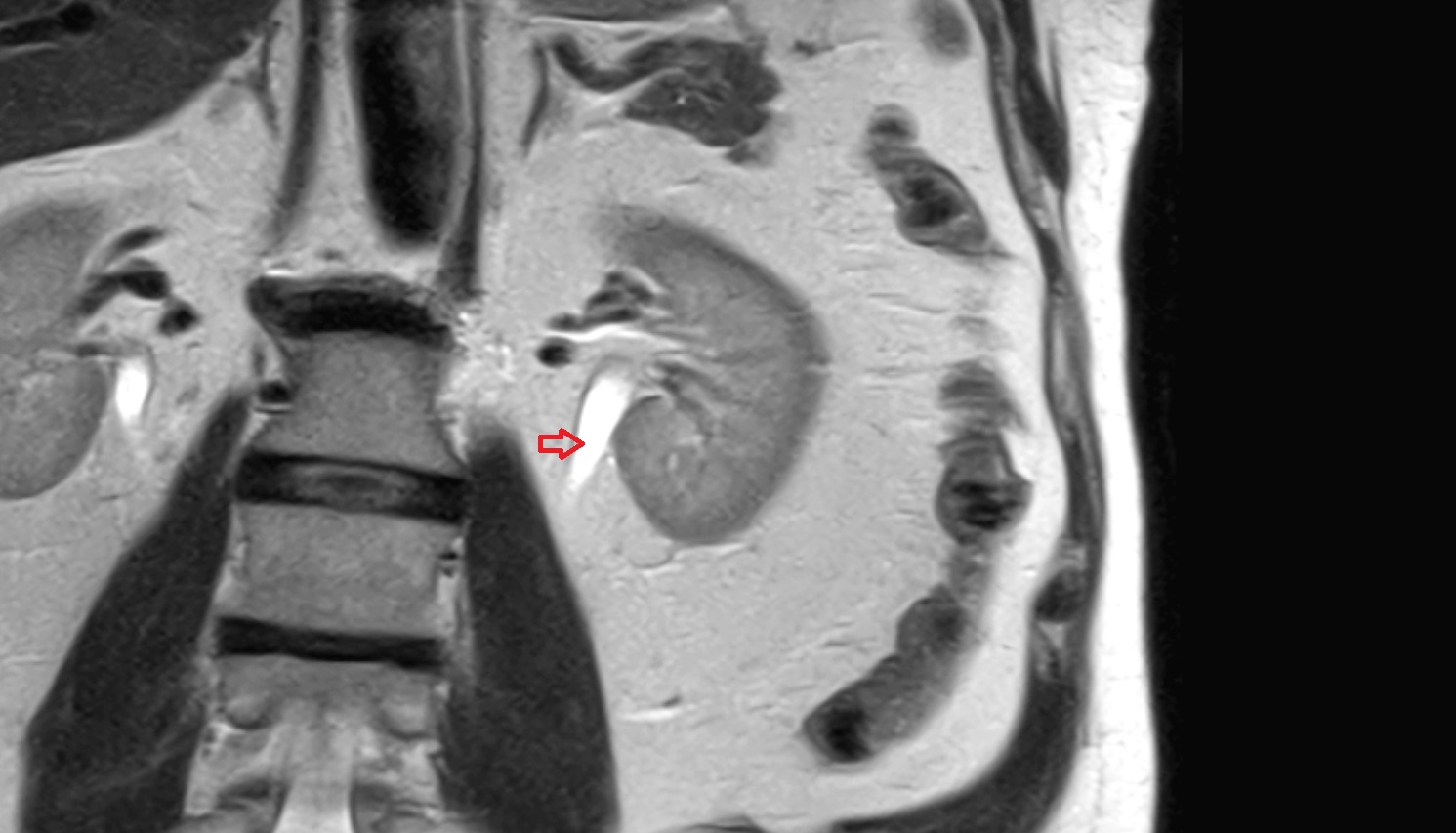 ureteropelvic junction  MRI coronal image anatomy  image -img-00000-00000
