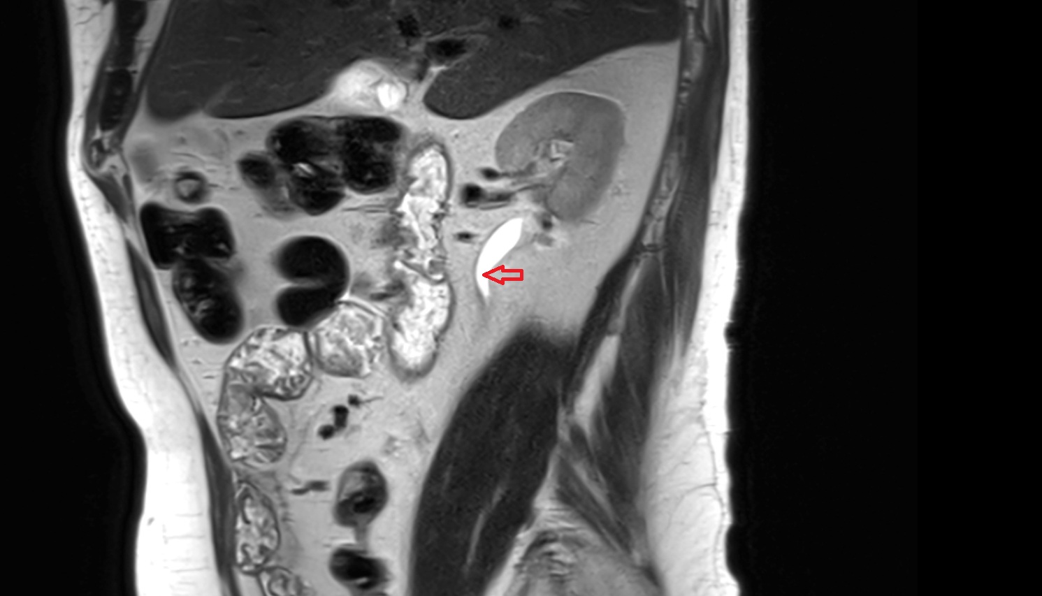 ureteropelvic junction  MRI sag image anatomy  image -img-00000-00000
