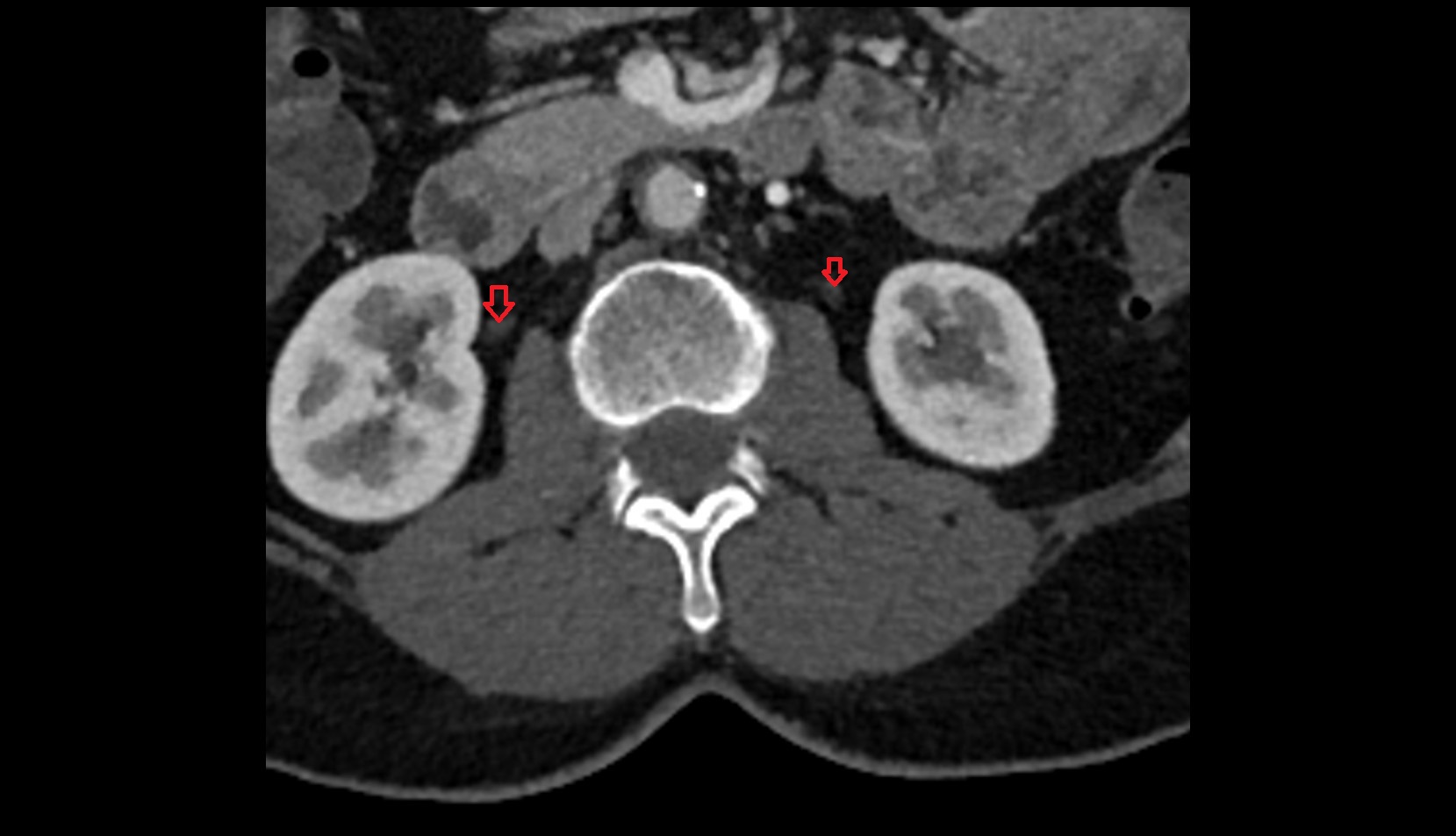 ureters  CT axial image